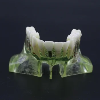 Инструмент за студенти-стоматолози 1бр, Модел за изследване на зъбни импланти, Мостовидный протеза за синуслифтинга горната челюст